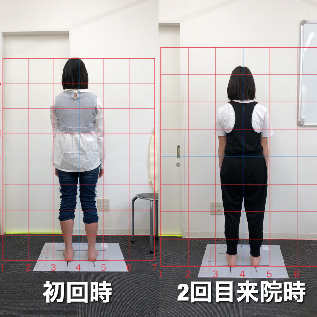 日常生活から姿勢の悪さが気になっていた女性