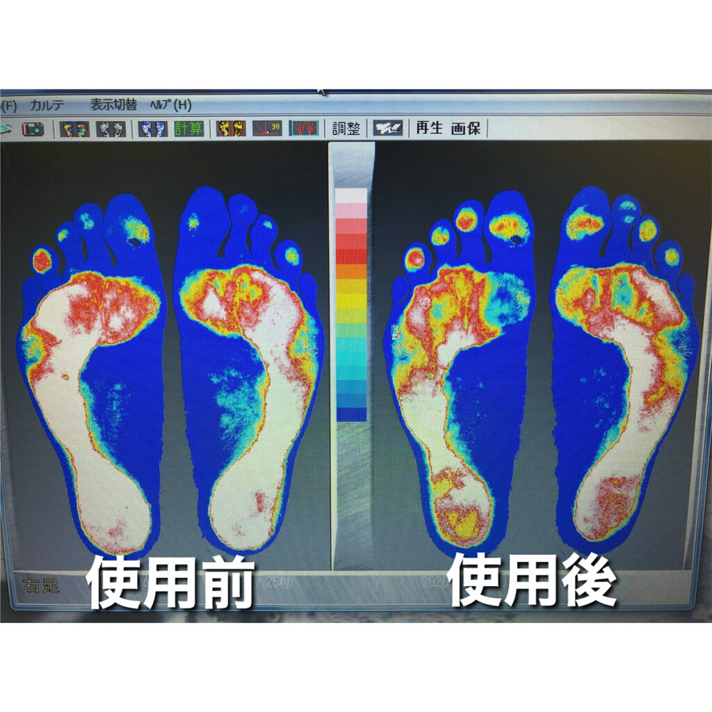 足裏の体重のかかり方が使用後に改善